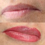 Pigmentatie lippen