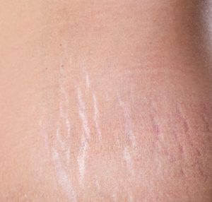 Striae behandeling