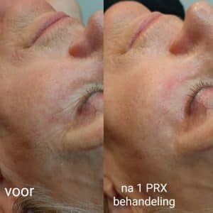 Voor en na een PRX therapie behandeling